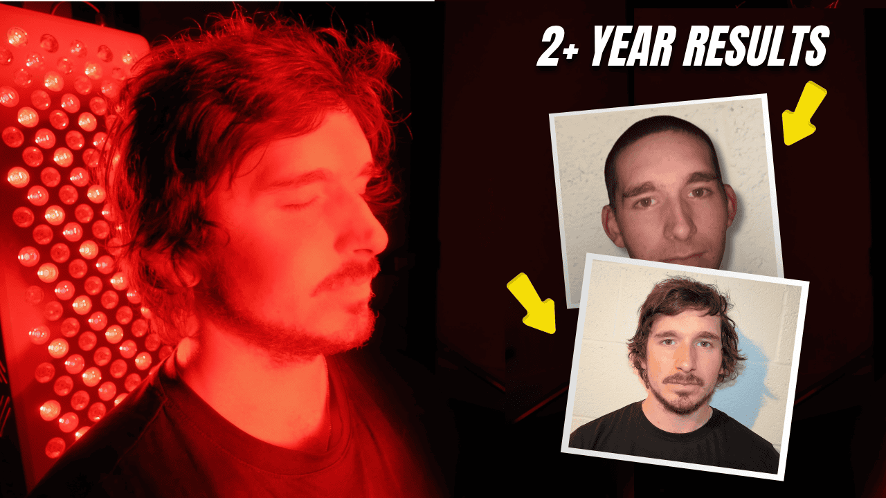 2 plus year results showing hair growth progression with red light therapy